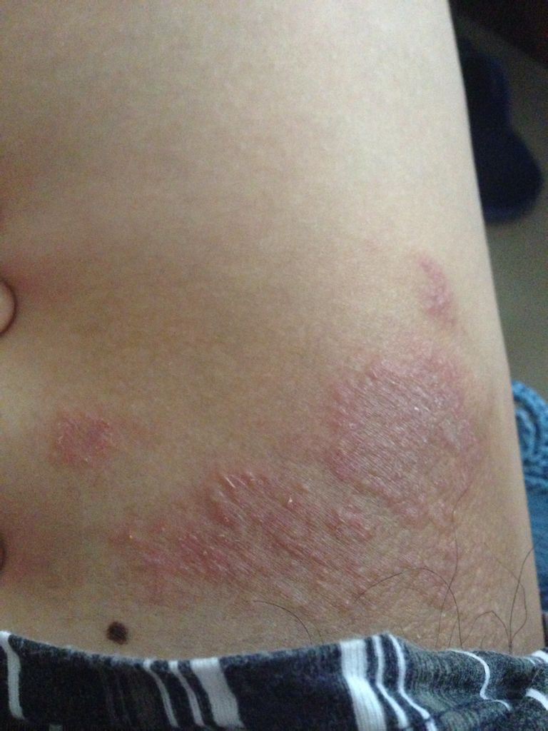 大腿根部很痒还有包,大腿根部很痒还有包块怎么办