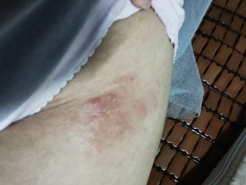 大腿根部很痒还有包,大腿根部很痒还有包块怎么办